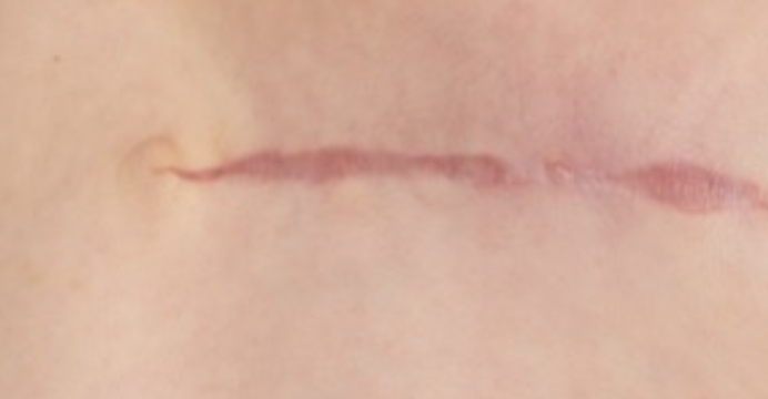 Treating Problem Scars: A Guide to Your Options